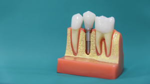 3 avantaje principale ale implanturilor dentare