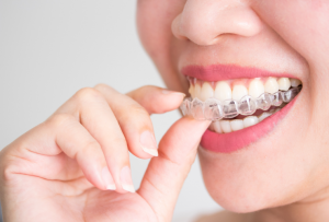 Cum alegi aparatul dentar potrivit pentru tine